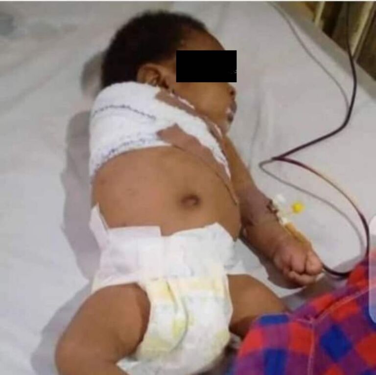 Horrific! Two-months old arm amputated after father’s assault
