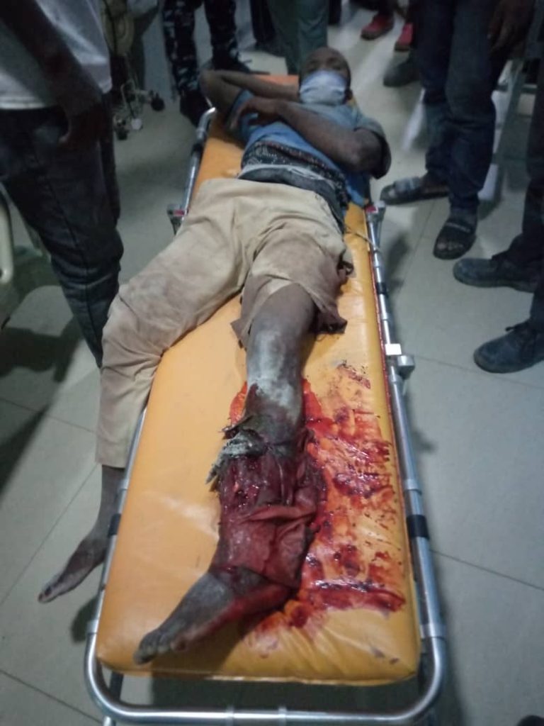 Nigerien victim loses leg days after Abuja building collapse