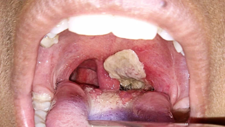 FCTA intensifies diphtheria response, engages traditional institution